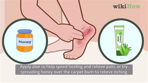 carpet burn cream|rug burn not forming scab.